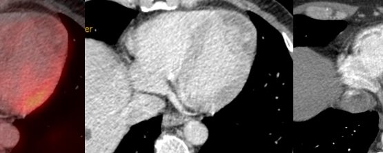 Tumeur cardiaque: hémangiome