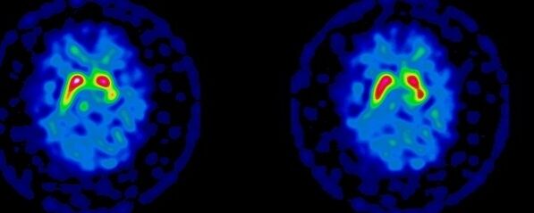 Médicaments interférant avec le Datscan