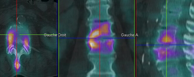 Spondylodiscite L2-L3