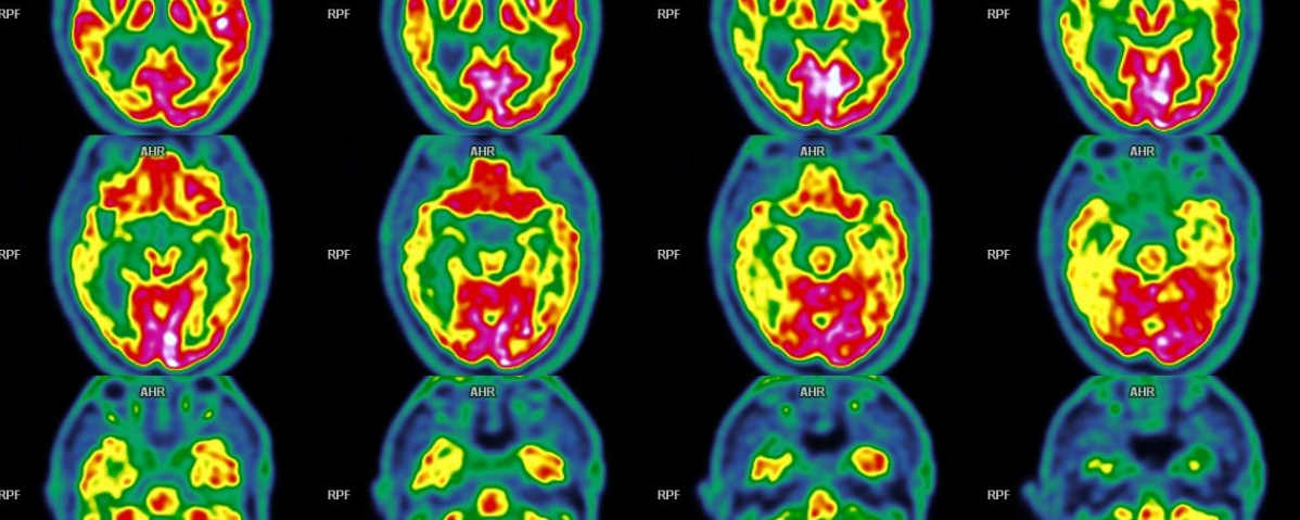 Maladie d’Alzheimer – TEP FDG