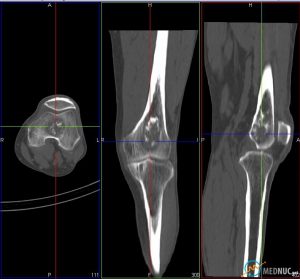 Enchondrome CT