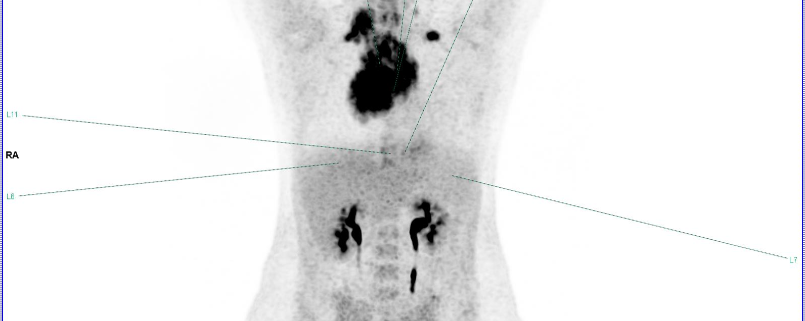 Lymphome : Evaluation de la réponse au traitement