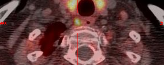 Adénome parathyroïdien – TEP Fluoro Choline