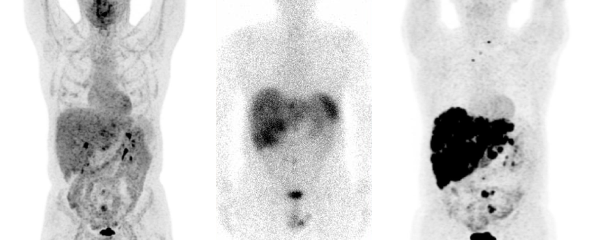 Tumeur Neuro Endocrine Grêle – TEP FDG – FDOPA – Octréoscan