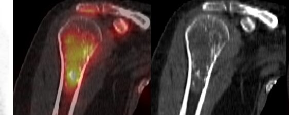 Enchondrome vs Chondrosarcome