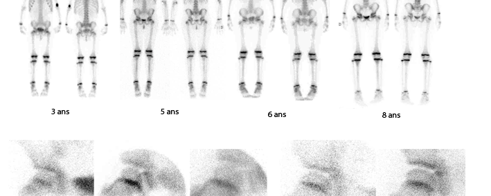 Scintigraphies osseuses normales enfants de 4 à 8 ans