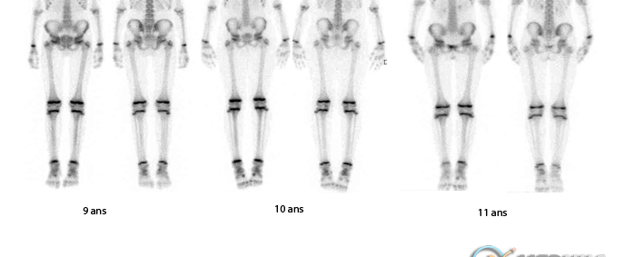 Scintigraphies osseuses en pédiatrie normales par âge et par sexe