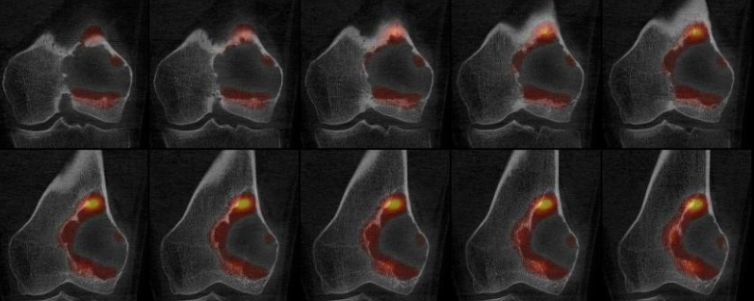 Tumeur à cellules géantes fémorale