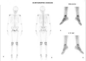 Synfibrose calcanéo-naviculaire - CE