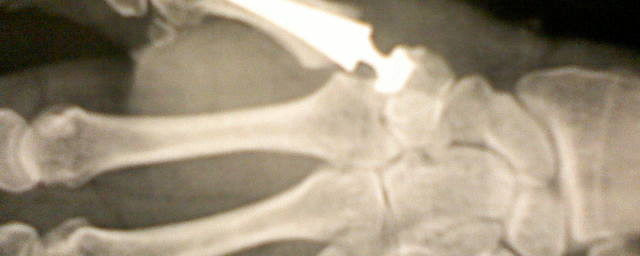 Descellement de prothèse trapézo-métacarpienne de la main gauche