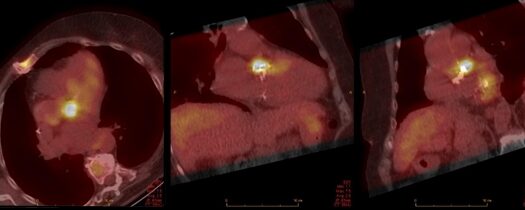 Infections cardio-vasculaires