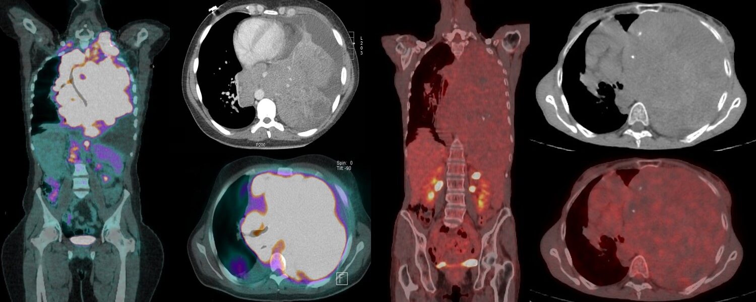 TEP FDG : hypermétabolisme en fonction du type de cancer