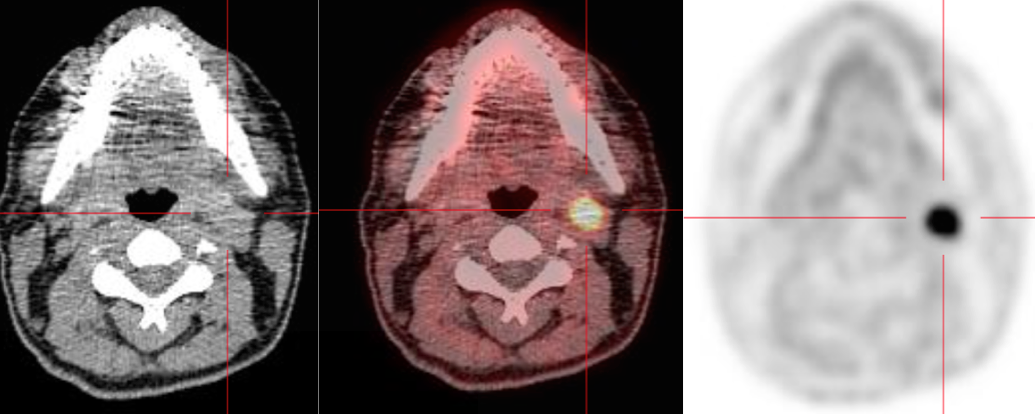 Paragangliome tympanique FDOPA