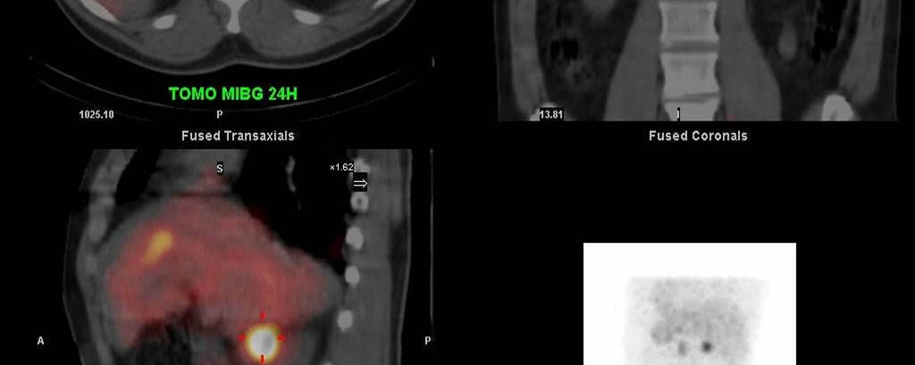 Phéochromocytome droit en SPECT-CT