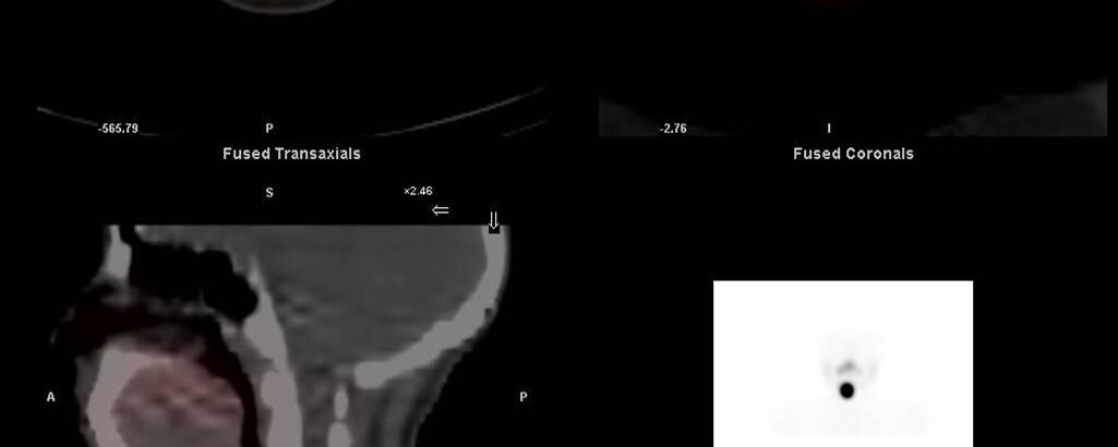 Hypothyroïdie et Nodule chaud ectopique