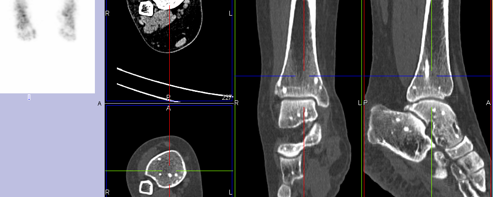 Osteopoecilie de découverte fortuite