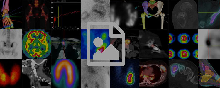 Shunt droit-gauche en scintigraphie pulmonaire au MAA-Tc99m