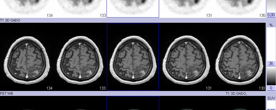 Suspicion de récidive tumorale cérébrale TEP-FDG