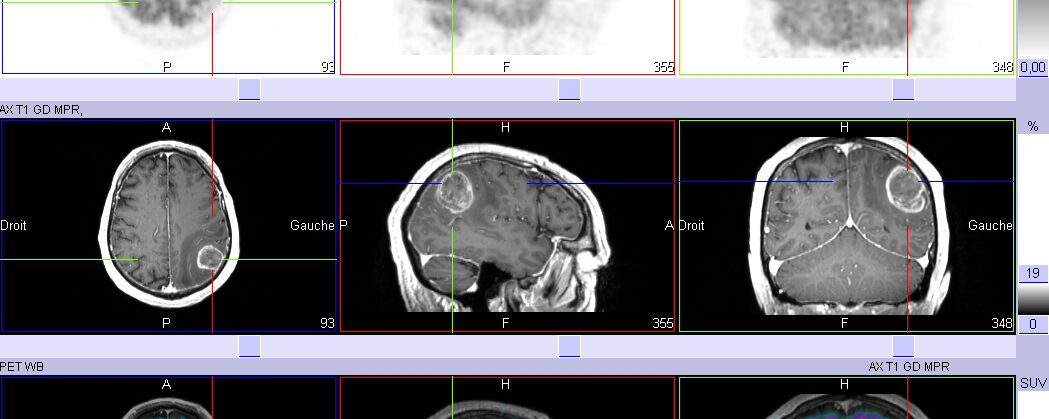 Récidive vs radionécrose tumorale cérébrale TEP-FDG