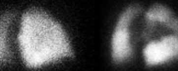 Embolies pulmonaires multiples bilatérales