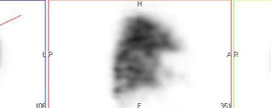 Embolie Pulmonaire du Segment 4 Gauche