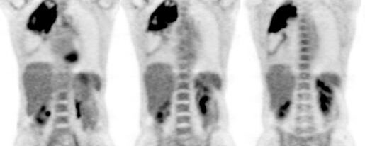 Tuberculose pulmonaire