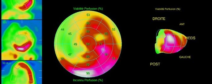 TEP-TDM 18FDG de viabilité cardiaque