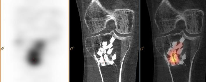 Comblement osseux tibial par substitut osseux