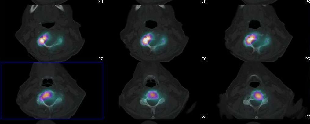 Métastase mixte cervicale d’un cancer du rein