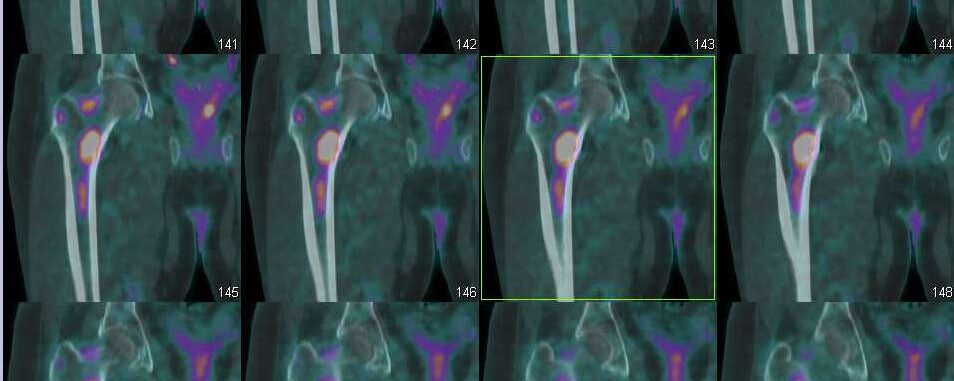 Myelome multiple