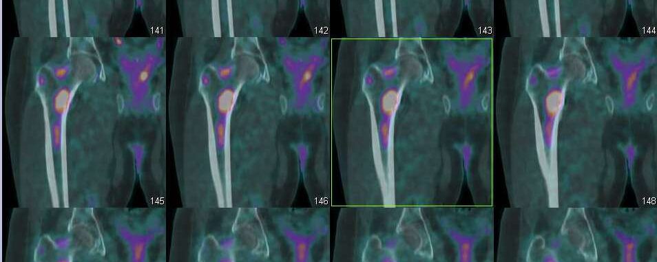 Myelome multiple