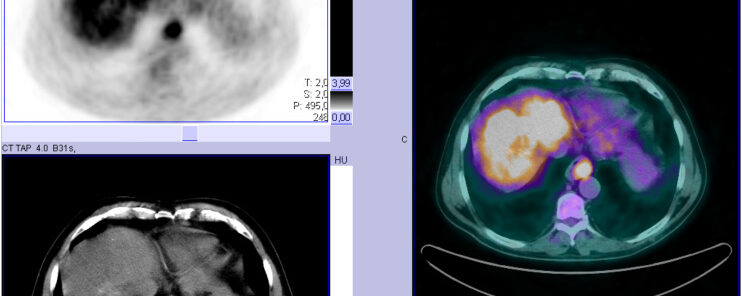 Neoplasie oesophagienne avec métastases hépatiques