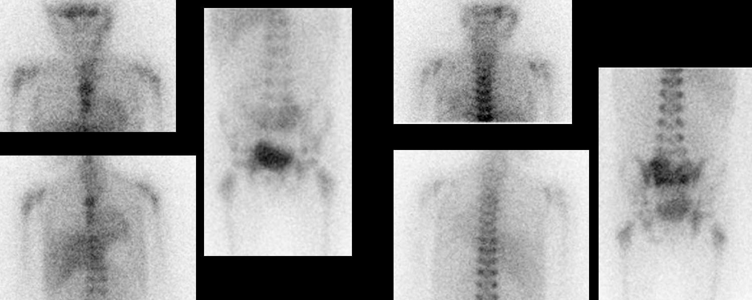Récidive de neuroblastome sous la forme de métastases osseuses