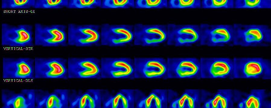 Ischémie inféro-latérale avec sidération myocardique à l’effort