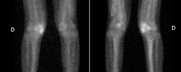 Myosite ossifiante associée à une paraosthéoarthropathie neurogène