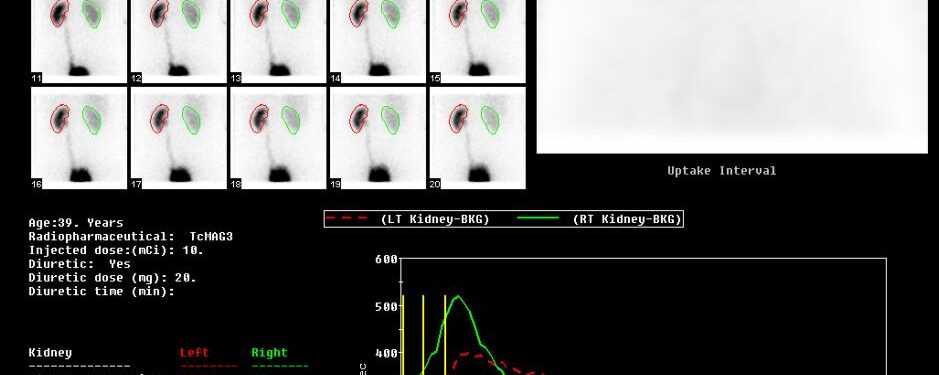 Dilatation pyélo-calicielle – méga-uretère