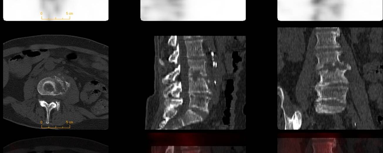 Spondylodiscite infectieuse