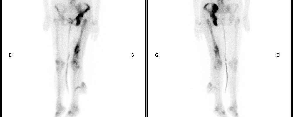 Métastases osseuse sur maladie de Paget