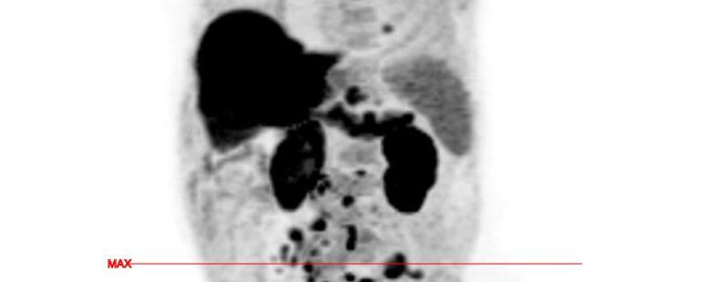 Fluorocholine et Carcinose péritonéale dans le cadre d’une néoplasie prostatique