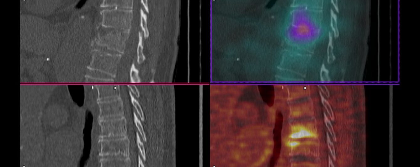 Spondylodiscite infectieuse