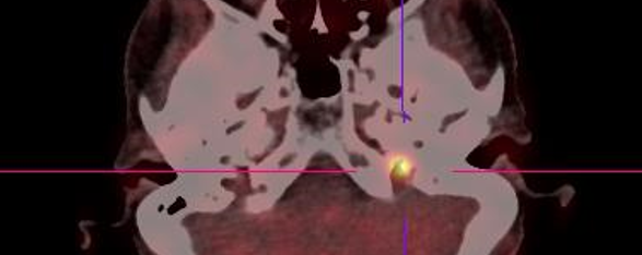 Base du crâne Foramen jugulaire. A propos d’un paragangliome jugulotympanique en FDOPA.