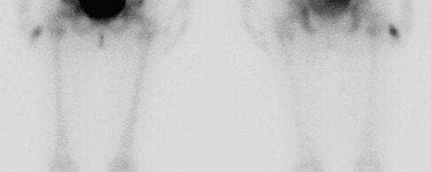 Quadramet – Samarium 153