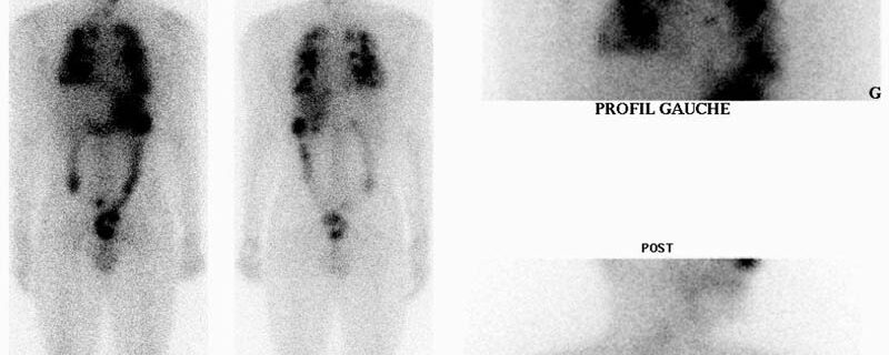 Exploration et traitement d’un cancer thyroïdien