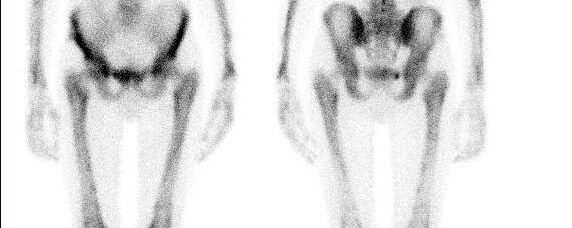 Néoplasie pulmonaire: Ostéoarthropathie hypertrophiante pneumique