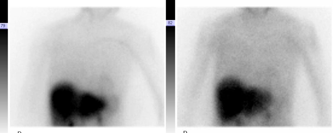 Scintigraphie 123I-MIBG: maladies de Parkinson et apparentées