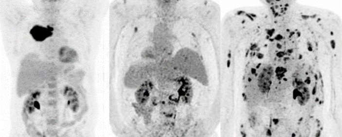 Plasmocytome et myélome : critères diagnostics