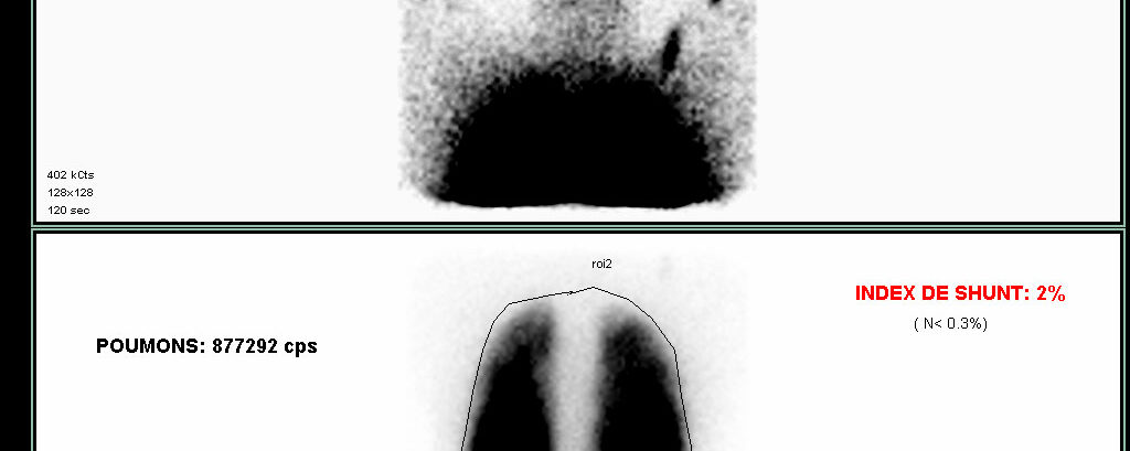 Syndrome hepato-pulmonaire (shunt)