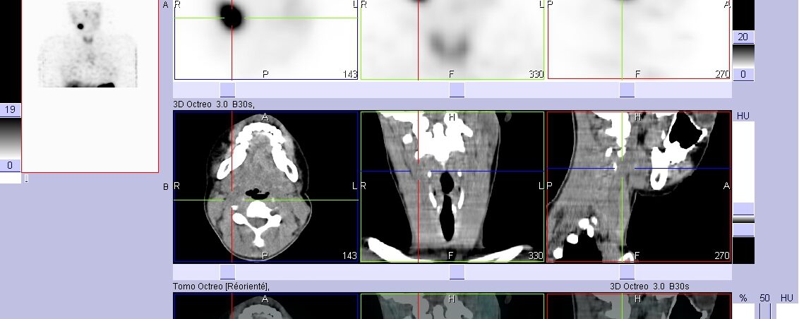 Paragangliome carotidien droit