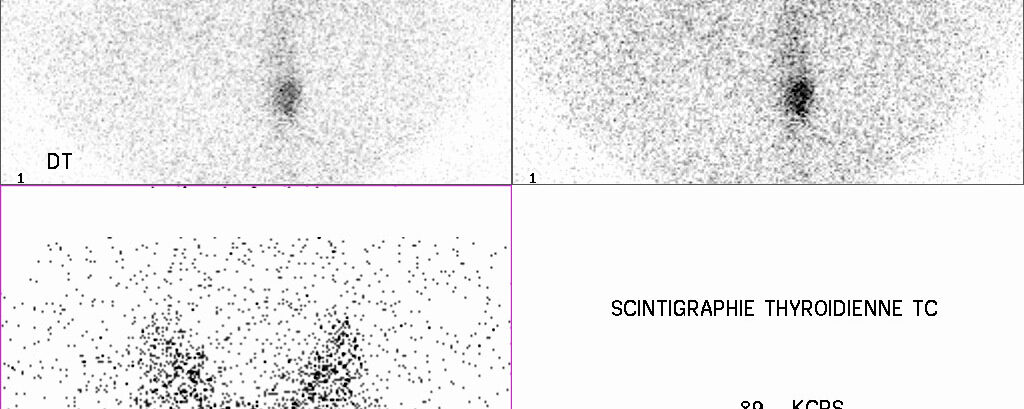 Activité digestive (salivaire) sur scintigraphie thyroïdienne