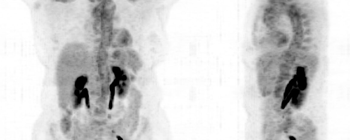 Vascularite compliquée d’une dissection aortique